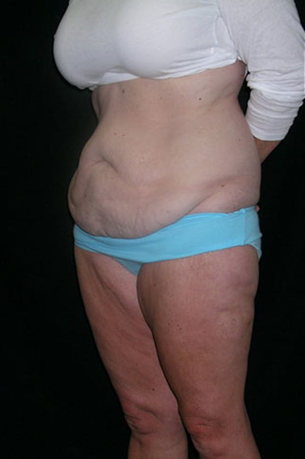 Tummy Tuck Before & After Gallery - Patient 23533893 - Image 3
