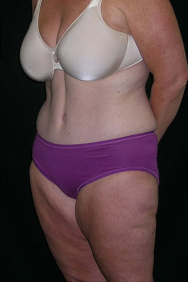 Tummy Tuck Before & After Gallery - Patient 23533893 - Image 4