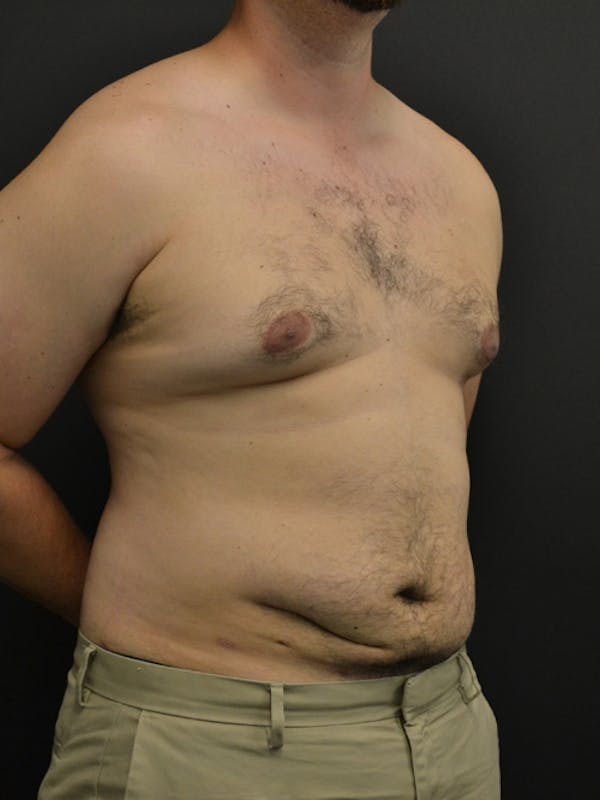 Liposuction & SmartLipo Before & After Gallery - Patient 23533892 - Image 4