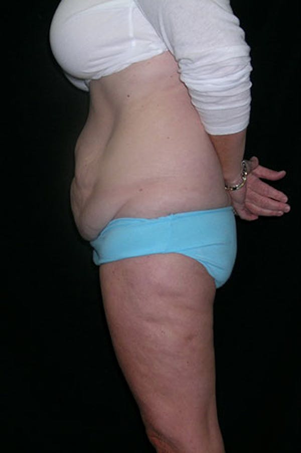 Tummy Tuck Gallery - Patient 23533893 - Image 5