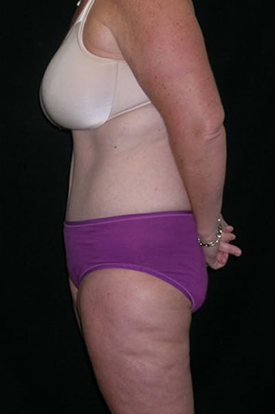 Tummy Tuck Before & After Gallery - Patient 23533893 - Image 6