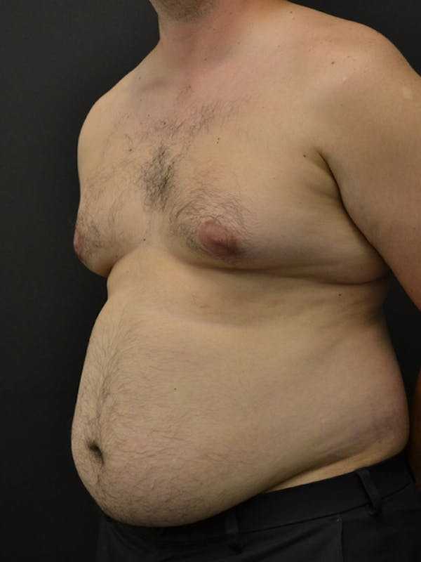 Liposuction & SmartLipo Before & After Gallery - Patient 23533892 - Image 5