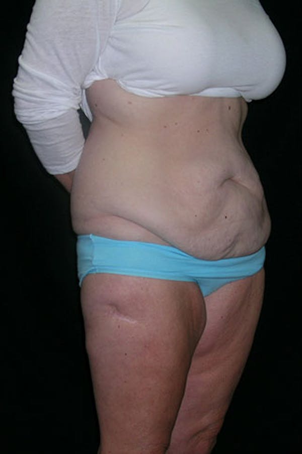 Tummy Tuck Before & After Gallery - Patient 23533893 - Image 7