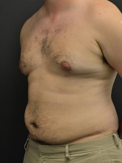 Liposuction & SmartLipo Before & After Gallery - Patient 23533892 - Image 6