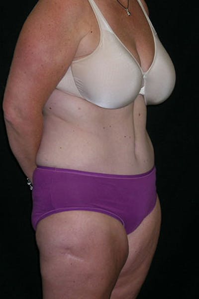 Tummy Tuck Before & After Gallery - Patient 23533893 - Image 8