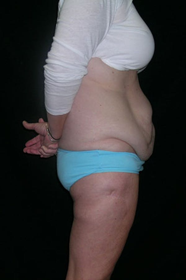 Tummy Tuck Before & After Gallery - Patient 23533893 - Image 9