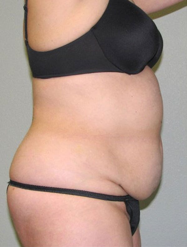 Liposuction & SmartLipo Before & After Gallery - Patient 23533894 - Image 1