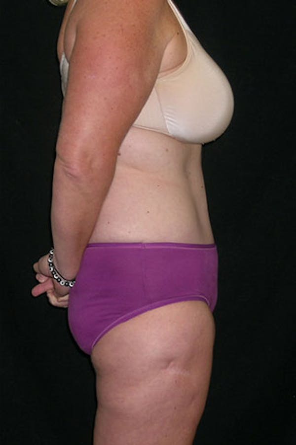 Tummy Tuck Before & After Gallery - Patient 23533893 - Image 10
