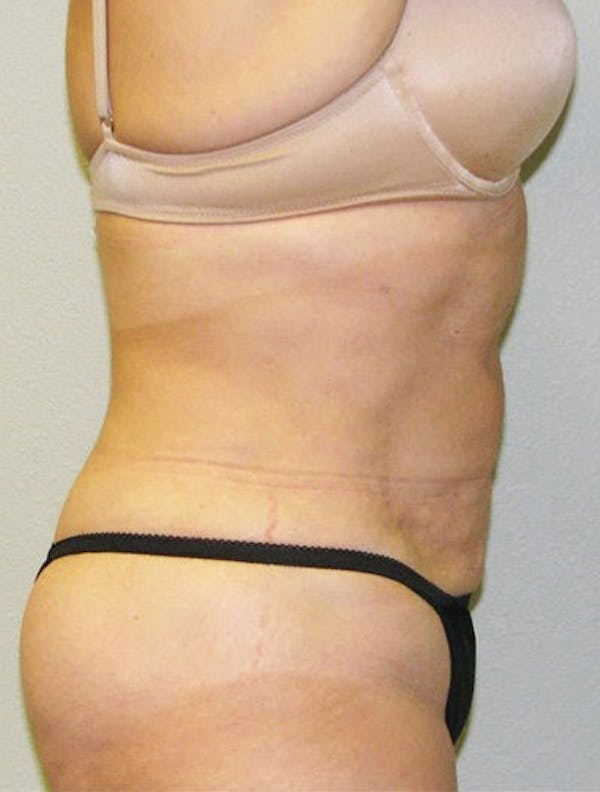 Liposuction & SmartLipo Gallery - Patient 23533894 - Image 2