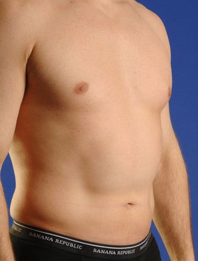 Liposuction & SmartLipo Before & After Gallery - Patient 23533897 - Image 1
