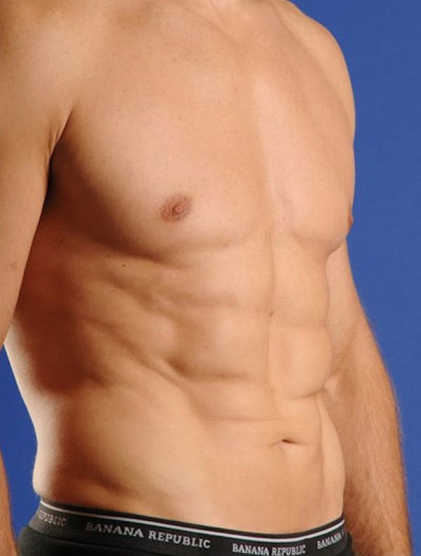 Liposuction & SmartLipo Before & After Gallery - Patient 23533897 - Image 2