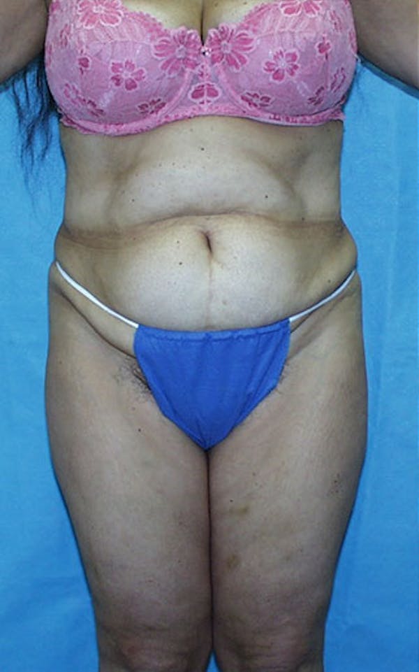 Tummy Tuck Before & After Gallery - Patient 23533903 - Image 1