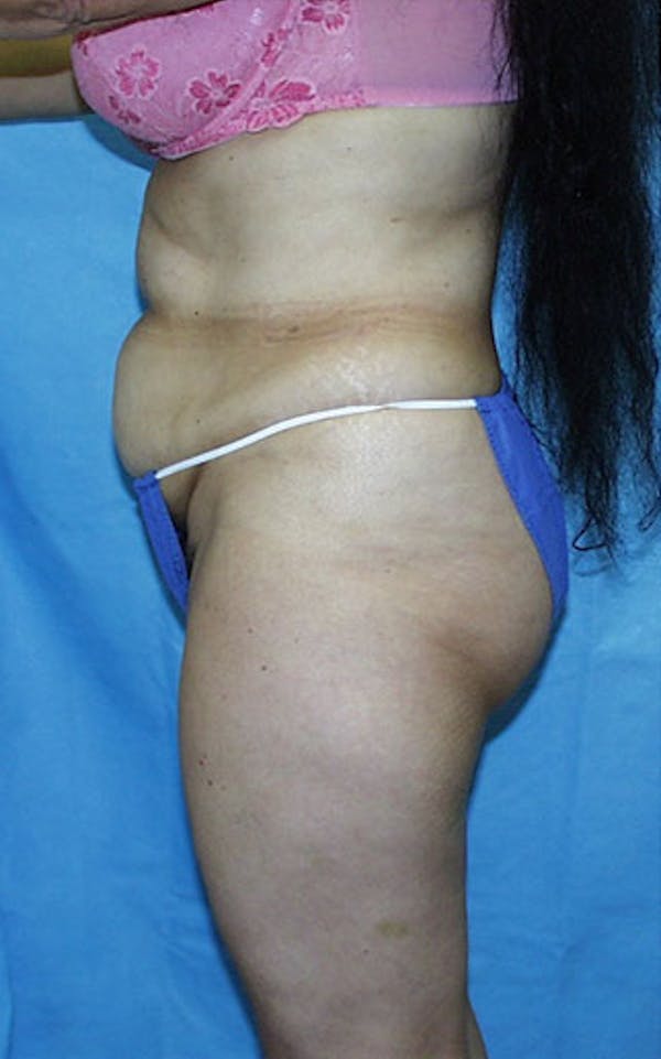 Tummy Tuck Before & After Gallery - Patient 23533903 - Image 3