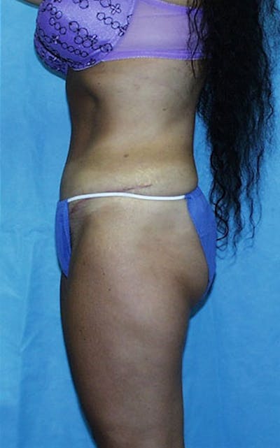 Tummy Tuck Before & After Gallery - Patient 23533903 - Image 4