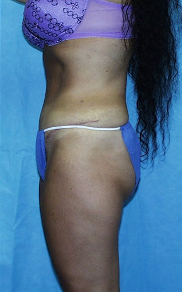 Tummy Tuck Before & After Gallery - Patient 23533903 - Image 4