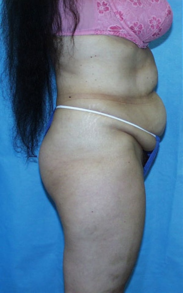 Tummy Tuck Before & After Gallery - Patient 23533903 - Image 5