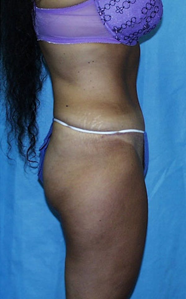 Tummy Tuck Before & After Gallery - Patient 23533903 - Image 6