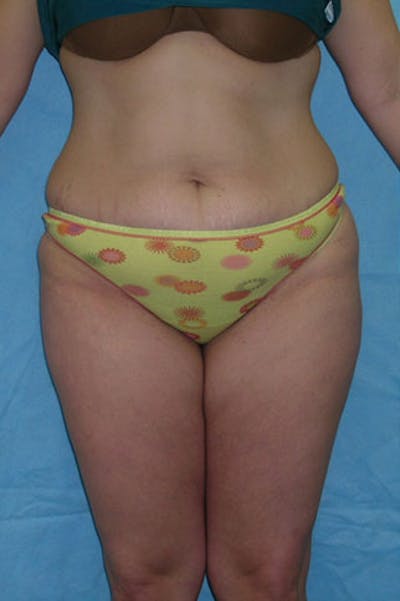 Tummy Tuck Before & After Gallery - Patient 23533908 - Image 1