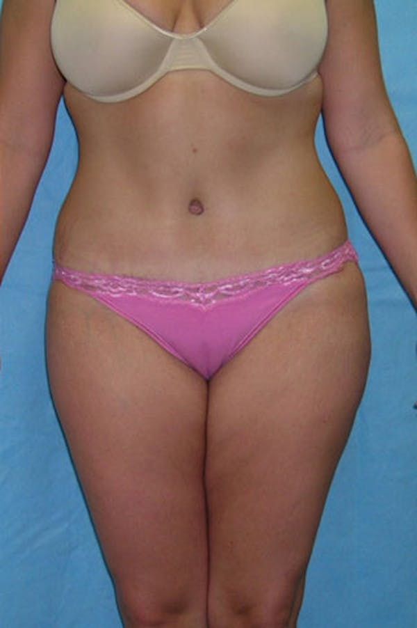 Tummy Tuck Before & After Gallery - Patient 23533908 - Image 2