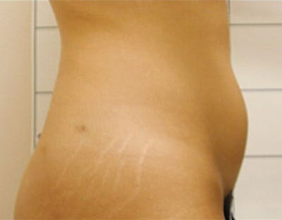 Liposuction & SmartLipo Before & After Gallery - Patient 23533906 - Image 1