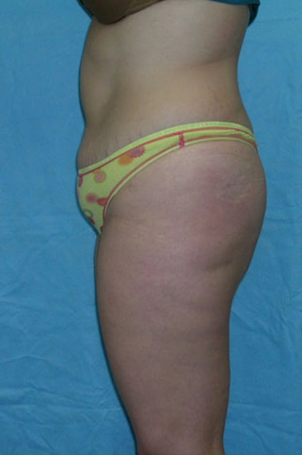 Tummy Tuck Before & After Gallery - Patient 23533908 - Image 3