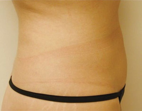 Liposuction & SmartLipo Before & After Gallery - Patient 23533906 - Image 2