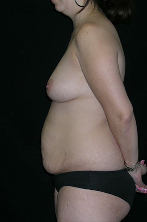 Mommy Makeover Gallery - Patient 23533910 - Image 3