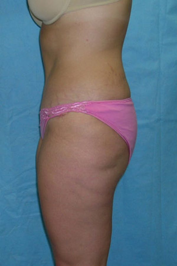 Tummy Tuck Before & After Gallery - Patient 23533908 - Image 4