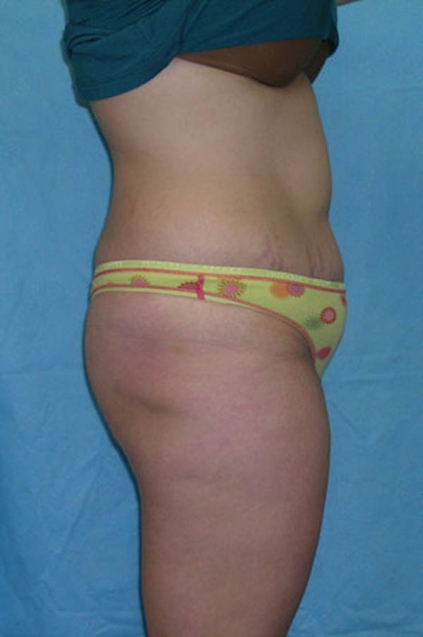 Tummy Tuck Before & After Gallery - Patient 23533908 - Image 5
