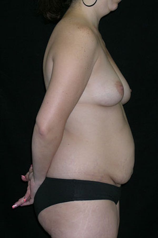Mommy Makeover Gallery - Patient 23533910 - Image 5