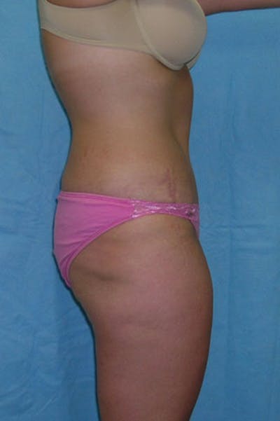 Tummy Tuck Before & After Gallery - Patient 23533908 - Image 6