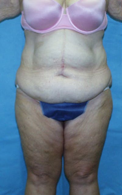 Tummy Tuck Before & After Gallery - Patient 23533913 - Image 1