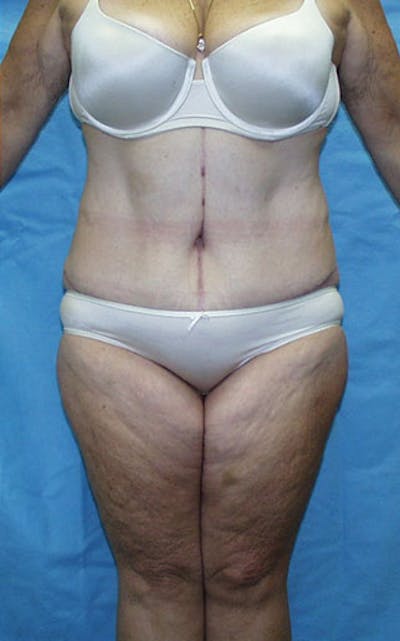 Tummy Tuck Before & After Gallery - Patient 23533913 - Image 2