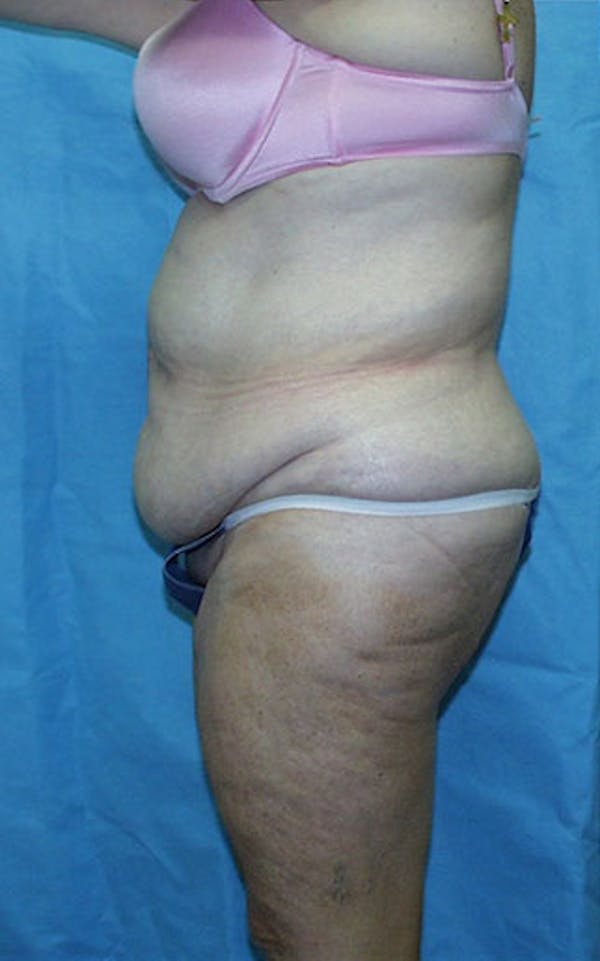 Tummy Tuck Before & After Gallery - Patient 23533913 - Image 3