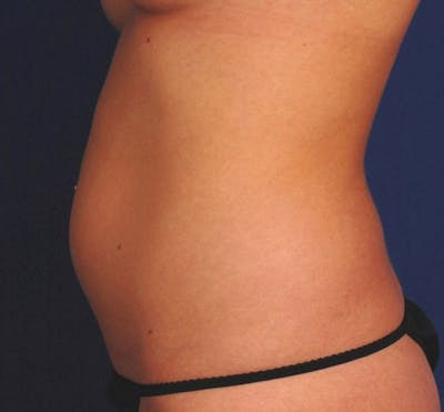 Liposuction & SmartLipo Before & After Gallery - Patient 23533911 - Image 1