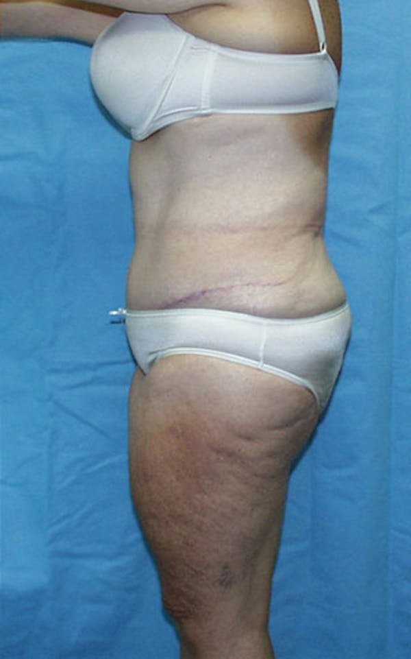 Tummy Tuck Before & After Gallery - Patient 23533913 - Image 4