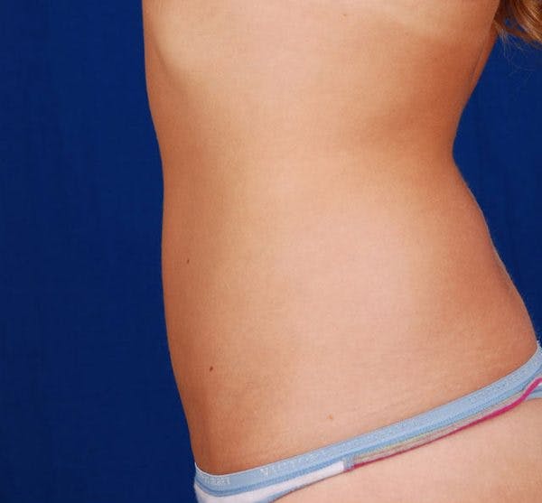 Liposuction & SmartLipo Before & After Gallery - Patient 23533911 - Image 2