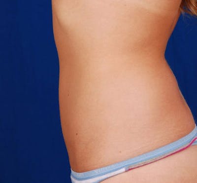Liposuction & SmartLipo Before & After Gallery - Patient 23533911 - Image 2