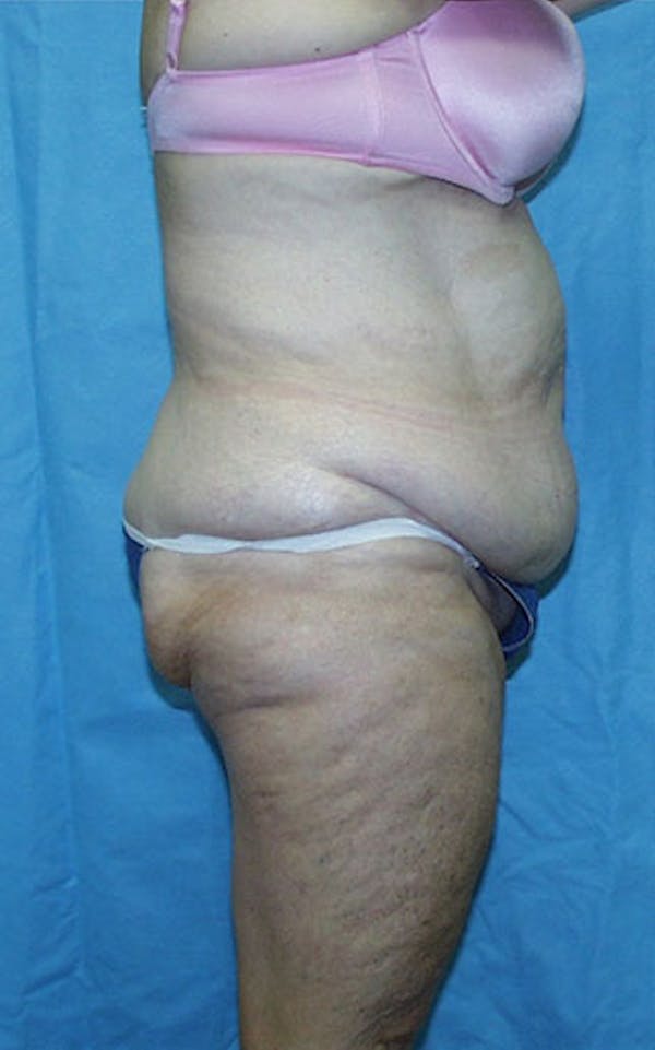 Tummy Tuck Before & After Gallery - Patient 23533913 - Image 5