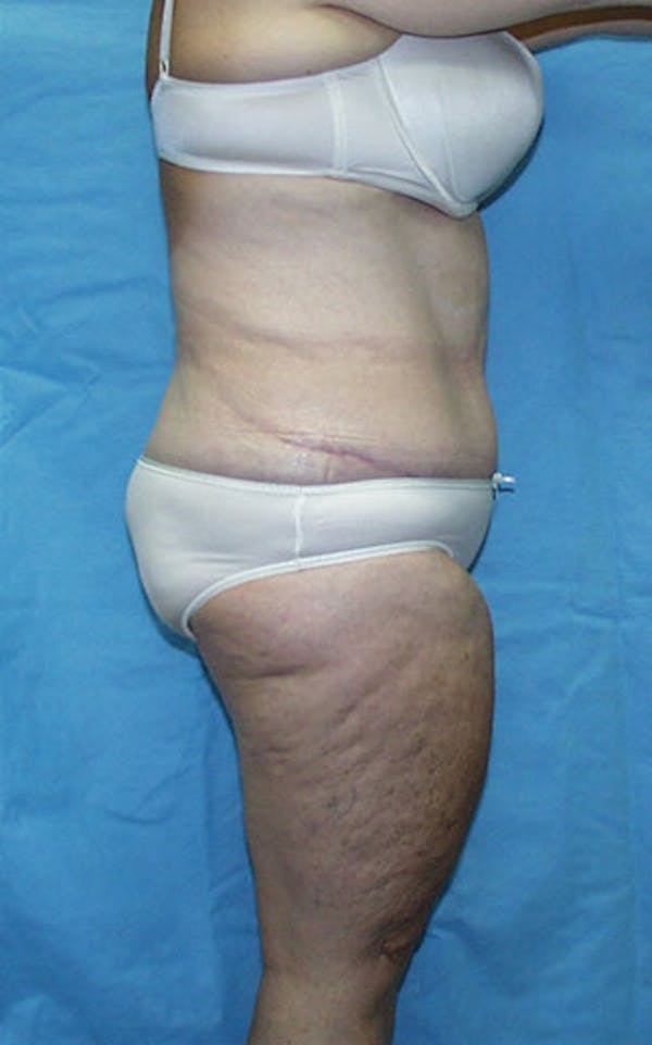 Tummy Tuck Before & After Gallery - Patient 23533913 - Image 6