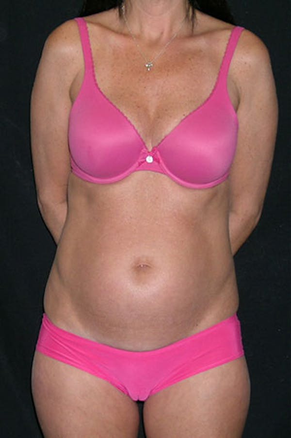 Tummy Tuck Before & After Gallery - Patient 23533915 - Image 1