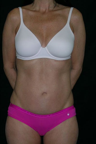 Tummy Tuck Before & After Gallery - Patient 23533915 - Image 2