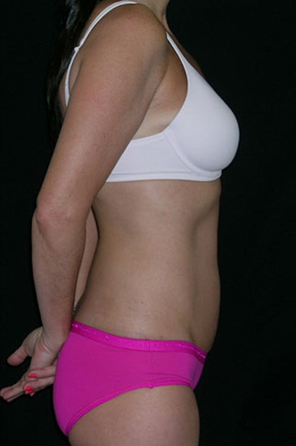 Tummy Tuck Before & After Gallery - Patient 23533915 - Image 4