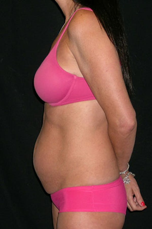 Tummy Tuck Before & After Gallery - Patient 23533915 - Image 5