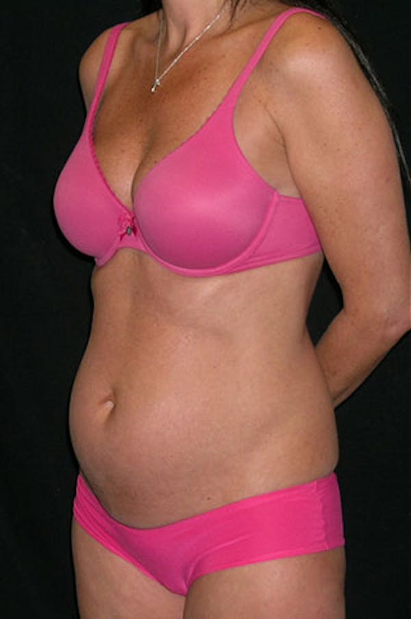 Tummy Tuck Before & After Gallery - Patient 23533915 - Image 7