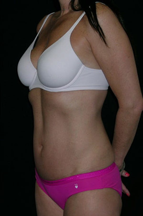 Tummy Tuck Before & After Gallery - Patient 23533915 - Image 8