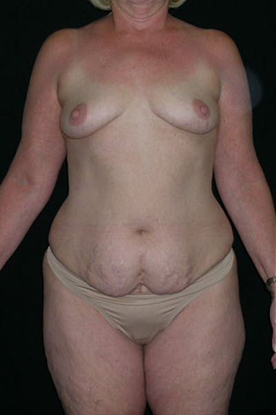Mommy Makeover Before & After Gallery - Patient 23533919 - Image 1