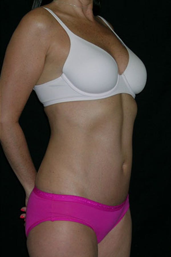 Tummy Tuck Before & After Gallery - Patient 23533915 - Image 10