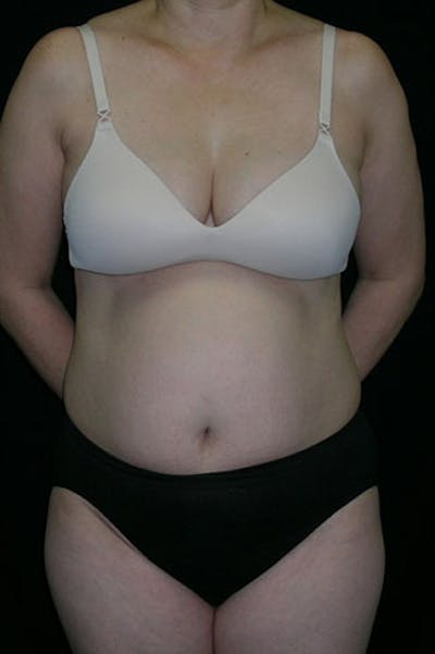 Tummy Tuck Before & After Gallery - Patient 23533917 - Image 1