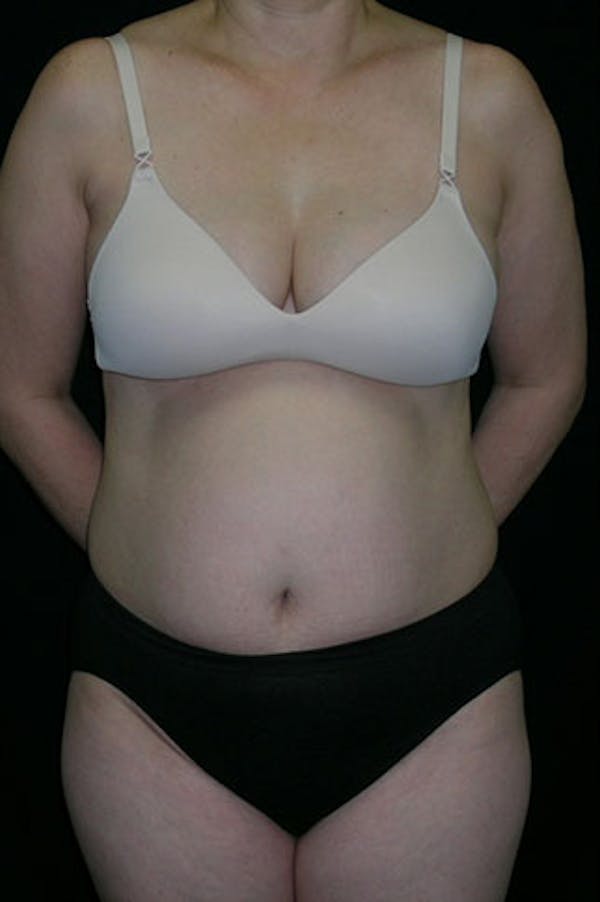 Tummy Tuck Before & After Gallery - Patient 23533917 - Image 1